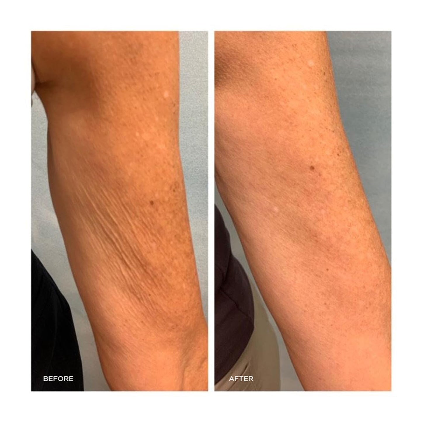 Moisturizing Body Repair Treatment: Reduce Crepey Skin and Wrinkle Visibly - Hydrating, Firming, Softening, Smooth Anti-Aging Cream For Body with Collagen and Elastin - 5 fl oz